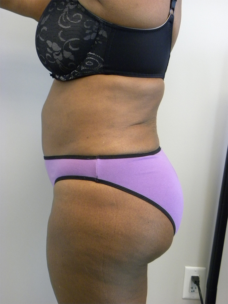 Tummy Tuck Before and After Pictures Miami, FL