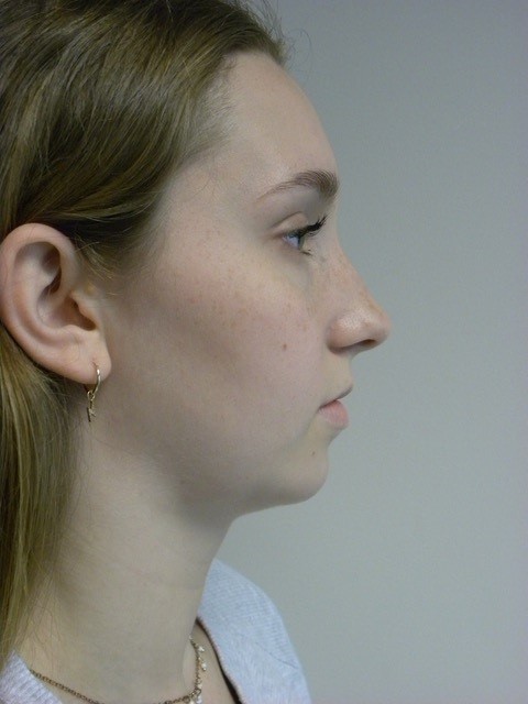 CHIN IMPLANT BEFORE AND AFTER PICTURES IN MIAMI, FL