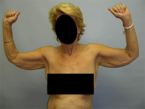 Arm Lift Before and After Pictures Miami, FL