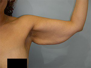 Arm Lift Before and After Pictures Miami, FL