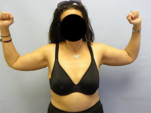 Arm Lift Before and After Pictures Miami, FL