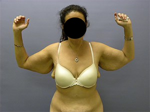 Arm Lift Before and After Pictures Miami, FL