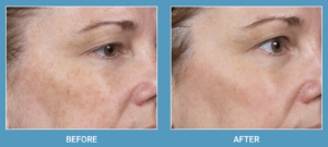Clear + Brilliant® Laser Before and After Pictures Miami, FL