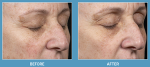 Clear + Brilliant® Laser Before and After Pictures Miami, FL