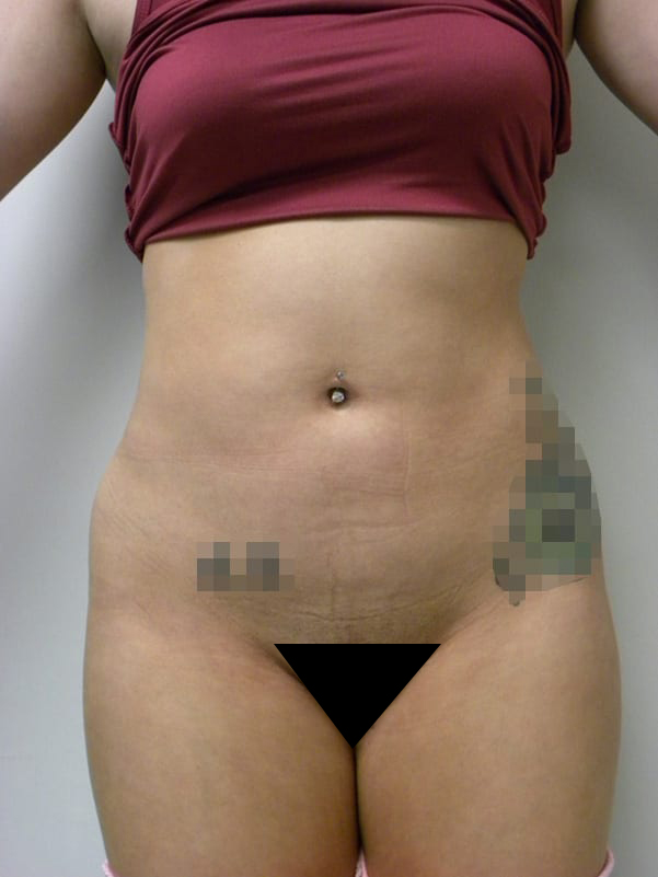 Brazilian Butt Lift Before and After Pictures Miami, FL