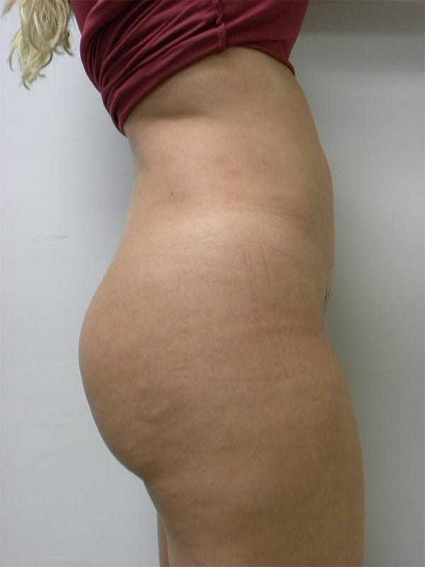 Brazilian Butt Lift Before and After Pictures Miami, FL