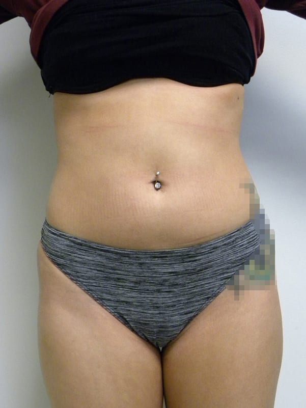 Brazilian Butt Lift Before and After Pictures Miami, FL