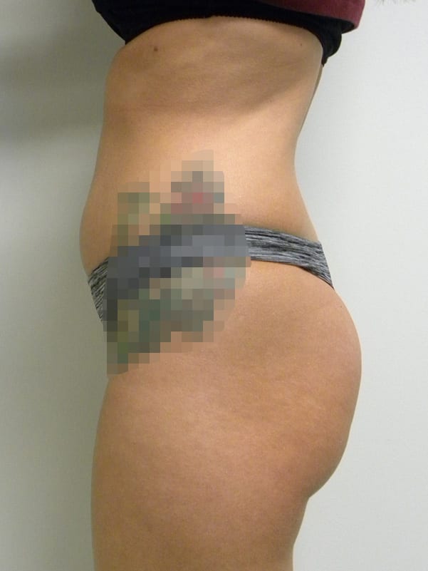 Brazilian Butt Lift Before and After Pictures Miami, FL