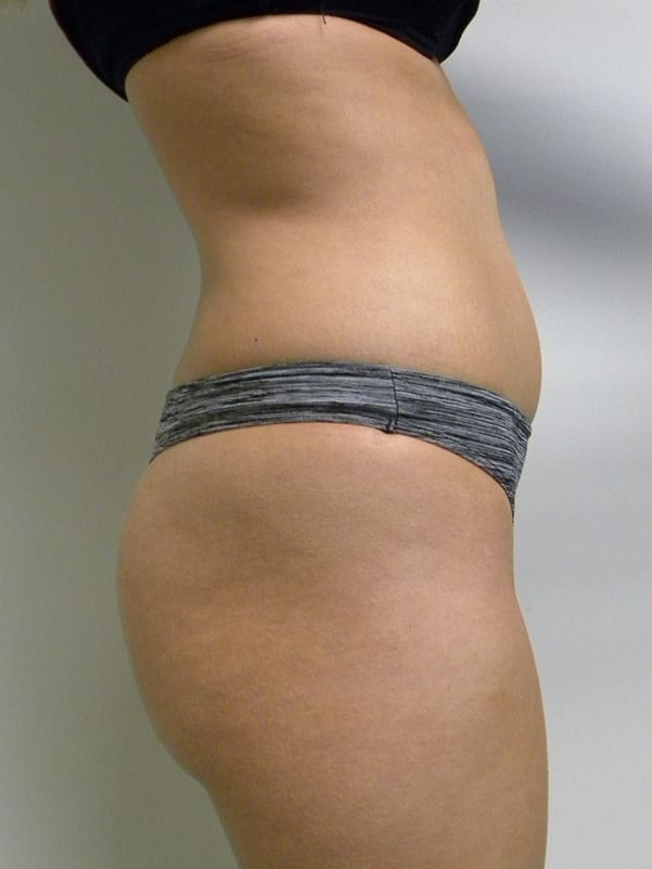 Brazilian Butt Lift Before and After Pictures Miami, FL