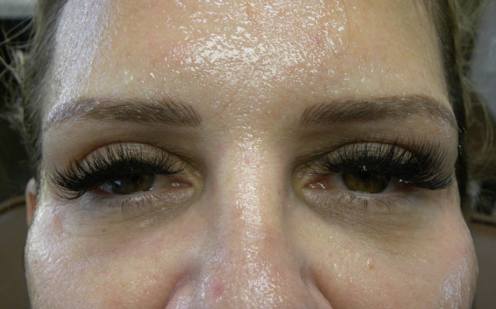 Blepharoplasty Before and After Pictures Miami, FL