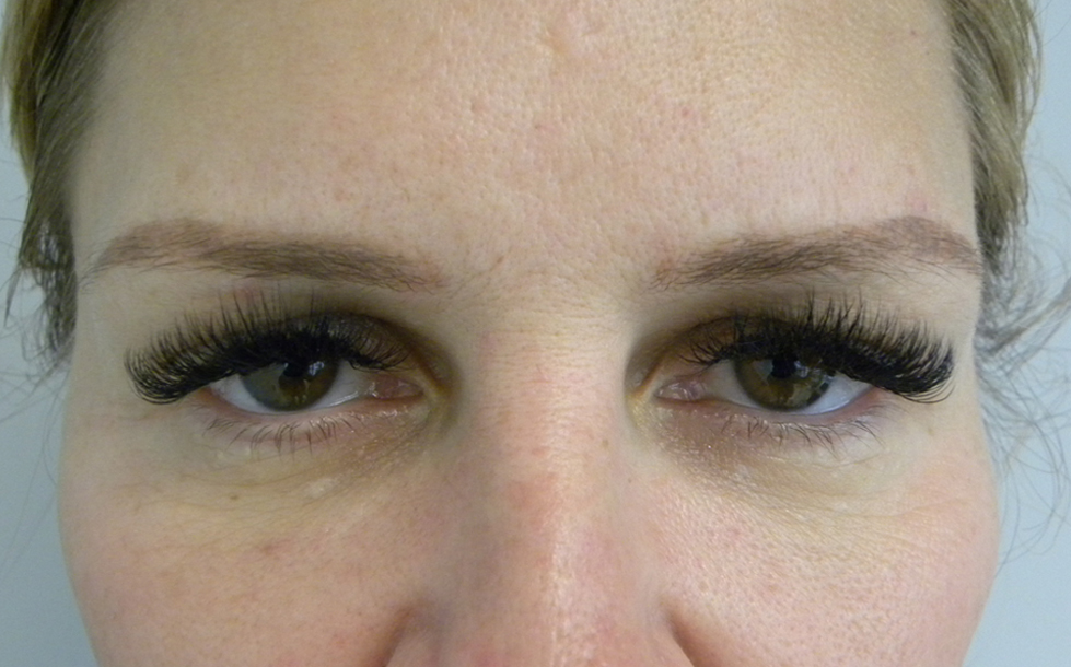 Blepharoplasty Before and After Pictures Miami, FL