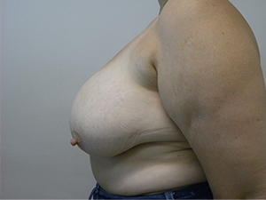 Breast Lift and Augmentation Before and After Pictures in Miami, FL