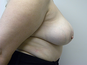 Breast Lift and Augmentation Before and After Pictures in Miami, FL