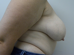 Breast Lift and Augmentation Before and After Pictures in Miami, FL