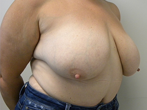 Breast Lift and Augmentation Before and After Pictures in Miami, FL