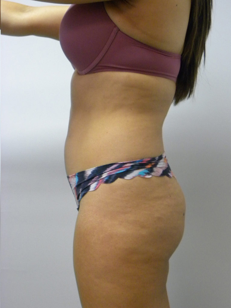 Liposuction Before and After Pictures Miami, FL