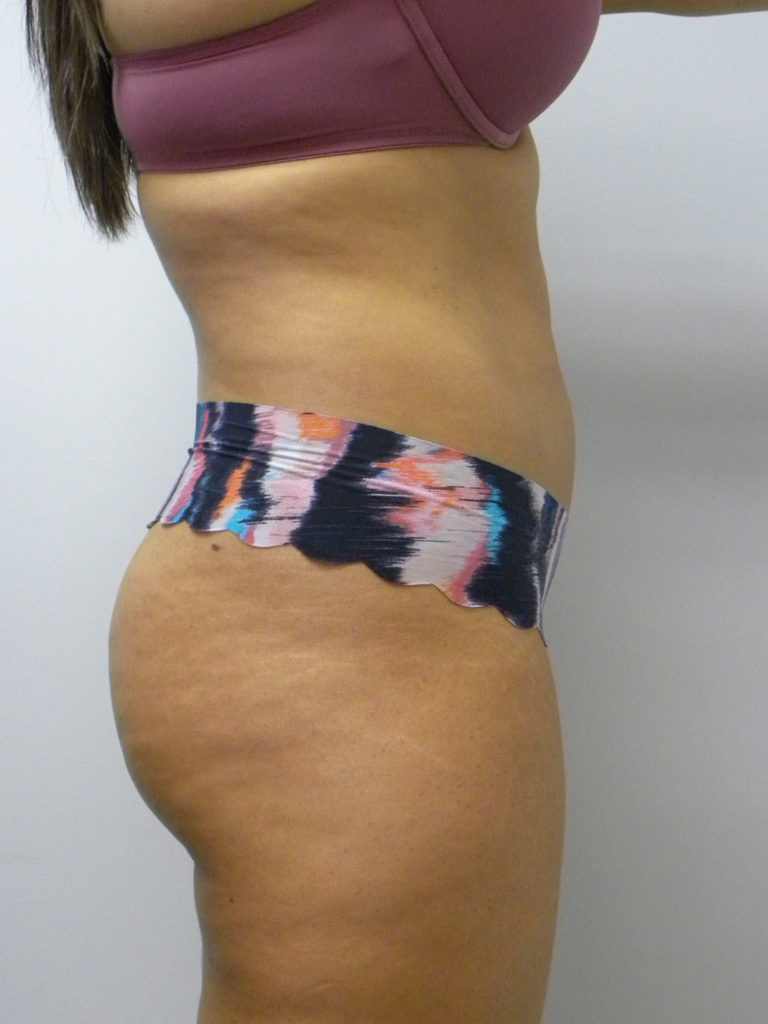 Liposuction Before and After Pictures Miami, FL