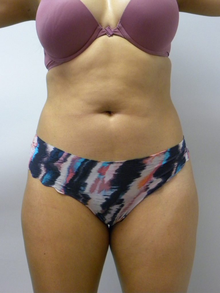 Liposuction Before and After Pictures Miami, FL