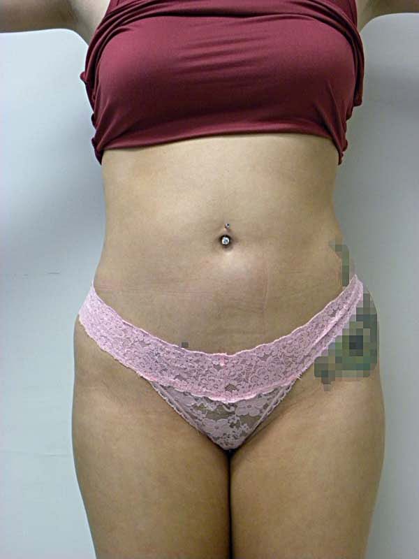 Liposuction Before and After Pictures Miami, FL