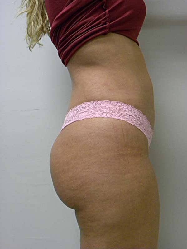 Liposuction Before and After Pictures Miami, FL