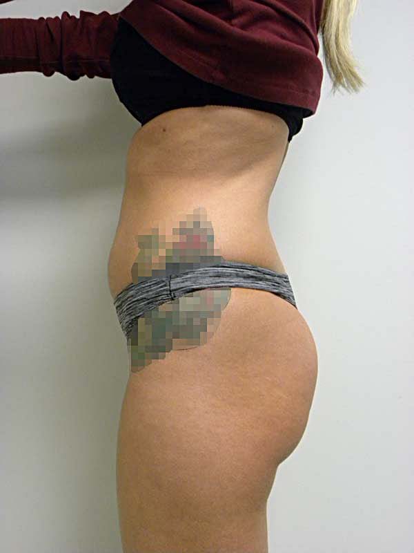 Liposuction Before and After Pictures Miami, FL