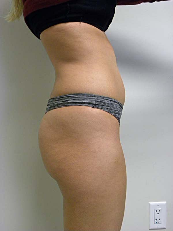 Liposuction Before and After Pictures Miami, FL