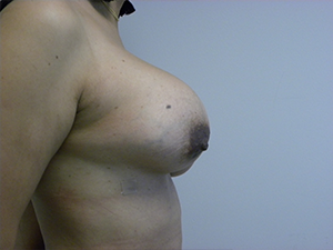 Revision Breast Augmentation Before and After Pictures in Miami, FL
