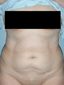 Tummy Tuck Before and After Pictures Miami, FL