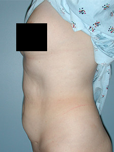 Tummy Tuck Before and After Pictures Miami, FL