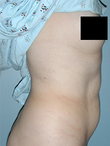 Tummy Tuck Before and After Pictures Miami, FL