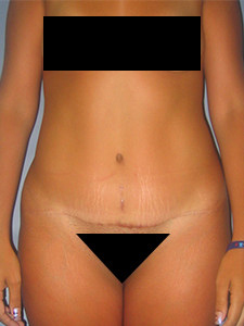 Tummy Tuck Before and After Pictures in Miami, FL