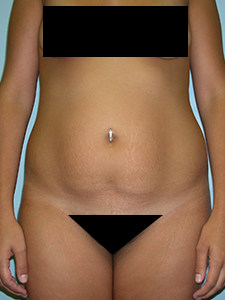 Tummy Tuck Before and After Pictures in Miami, FL