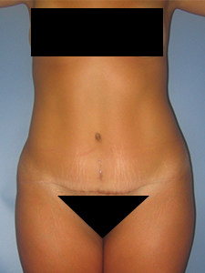 Tummy Tuck Before and After Pictures in Miami, FL