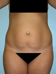 Tummy Tuck Before and After Pictures in Miami, FL