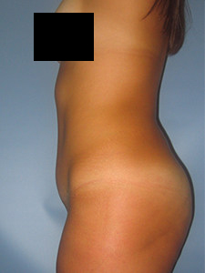 Tummy Tuck Before and After Pictures in Miami, FL