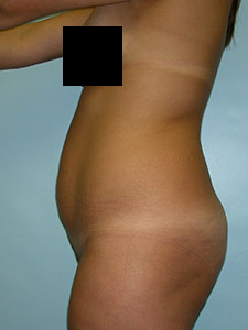 Tummy Tuck Before and After Pictures in Miami, FL