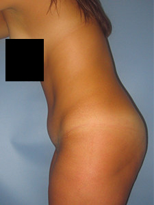 Tummy Tuck Before and After Pictures in Miami, FL