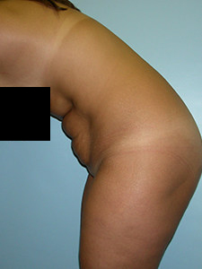 Tummy Tuck Before and After Pictures in Miami, FL