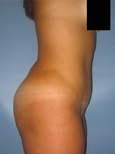 Tummy Tuck Before and After Pictures in Miami, FL