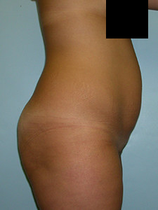 Tummy Tuck Before and After Pictures in Miami, FL