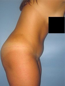 Tummy Tuck Before and After Pictures in Miami, FL