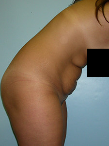 Tummy Tuck Before and After Pictures in Miami, FL