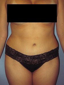 Tummy Tuck Before and After Pictures in Miami, FL