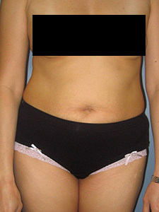 Tummy Tuck Before and After Pictures in Miami, FL