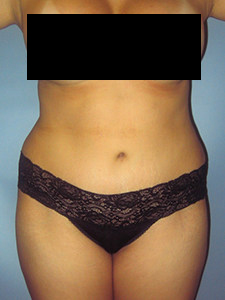 Tummy Tuck Before and After Pictures in Miami, FL