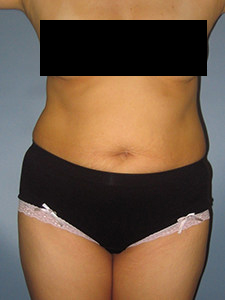 Tummy Tuck Before and After Pictures in Miami, FL