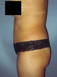 Tummy Tuck Before and After Pictures in Miami, FL