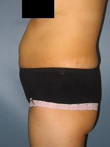 Tummy Tuck Before and After Pictures in Miami, FL