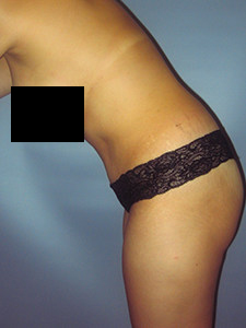 Tummy Tuck Before and After Pictures in Miami, FL