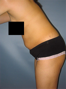 Tummy Tuck Before and After Pictures in Miami, FL